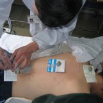 Needle-top moxibustion being performed in a Chinese medicine clinic in Chengdu 