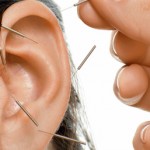 Ear acupuncture in Boulder, CO