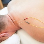 E-stim (electro) acupuncture in Boulder, CO